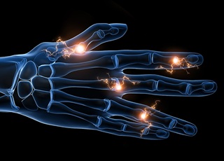 Rheumatoid Arthritis