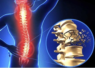 Spinal Pain